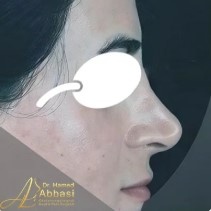 قبل از ترمیم