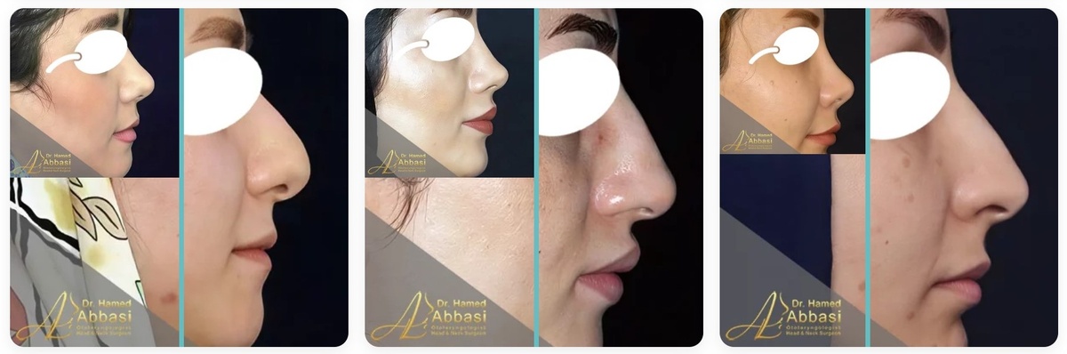 نمونه عمل های بینی طبیعی