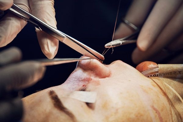 بخیه داخل بینی پس از عمل 