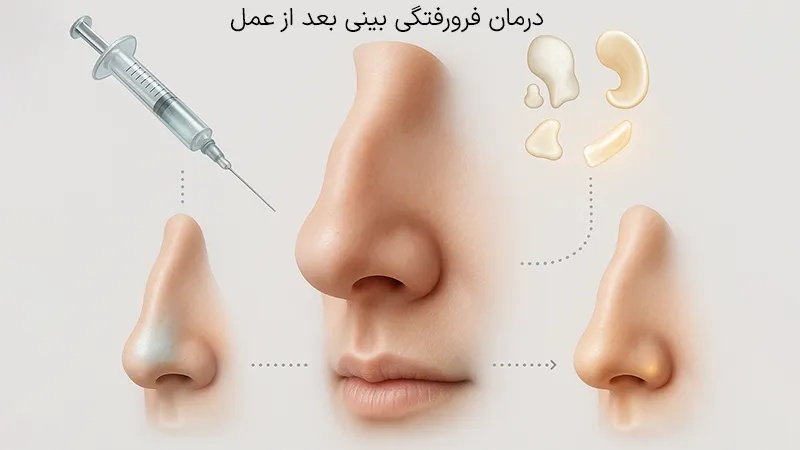 فرورفتگی بینی بعد از عمل