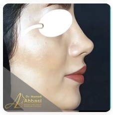 بینی فانتزی