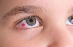 قرمزی چشم بعد از عمل بینی
