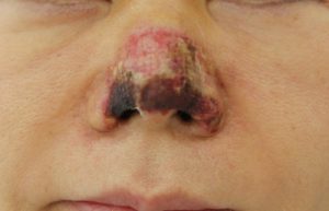 سیاه شدن پوست بینی بعد از عمل