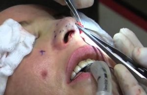 جراحی بینی بسته