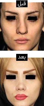 قبل و بعد جراحی بینی گوشتی
