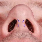 مراقبت از بخیه ها بعد از عمل بینی